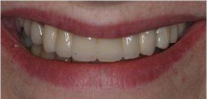 Implant Bridge Treatment in Carrollton