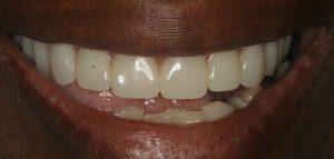 Denture Treatment in Carrollton ,Texas