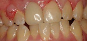 gum disease,Denture and Implants Texas