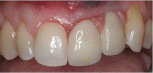 Single Implant Fixing ,Denture in Carrollton,Texas