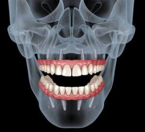 Dentures and Implants Carrollton Texas