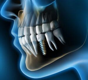 Denture and Implants