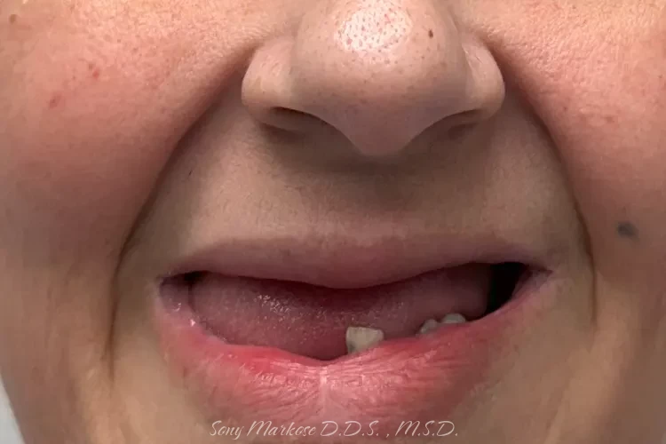 Denture fixing in Carrollton
