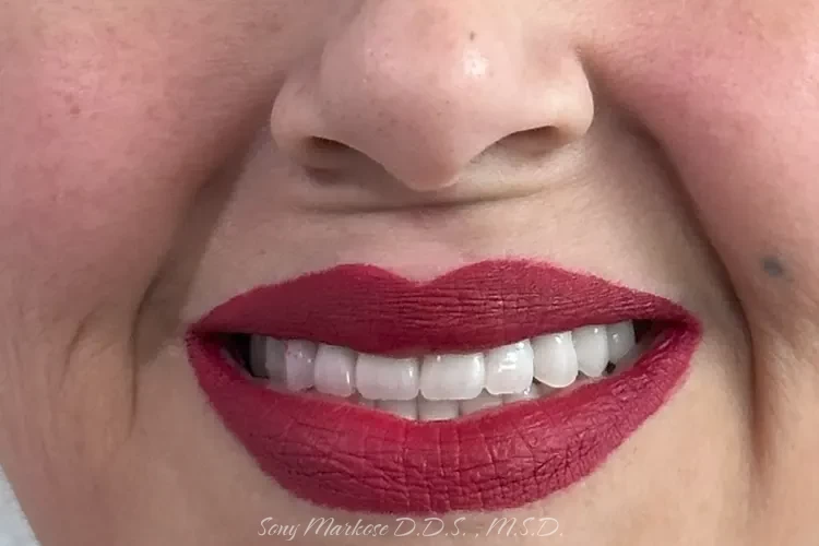 Denture fixing in Carrollton