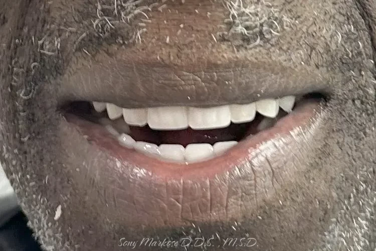 Denture fixing in Carrollton
