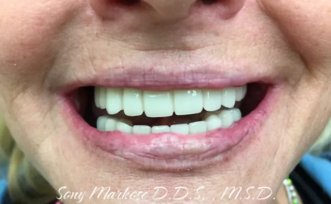 Full Denture in Carrollton