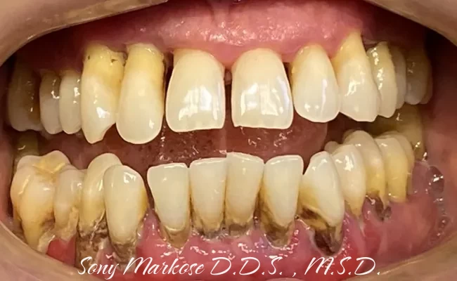 Full Denture in Carrollton