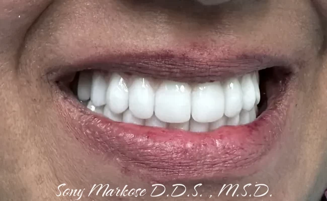 Full Denture in Carrollton