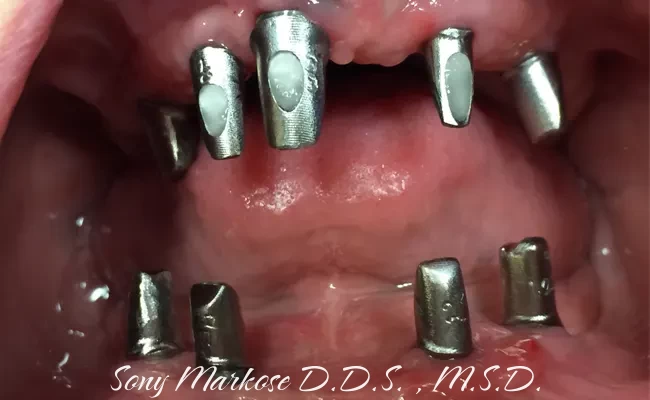 Full Denture in Carrollton