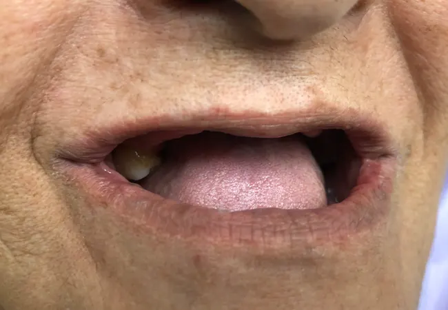 Medicare Dental PPO Patients in Carrollton, TX