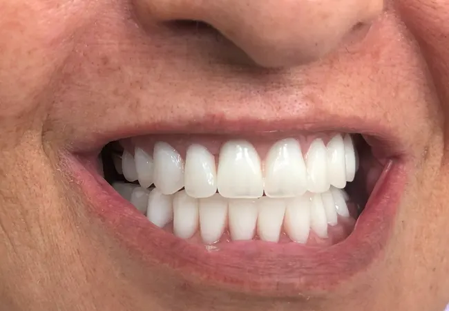 Medicare Dental PPO Patients in Carrollton, TX