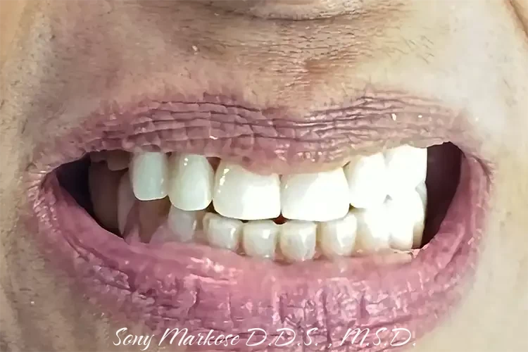 Dental Ceramic Crowns - front teeth Fixing in Carrollton