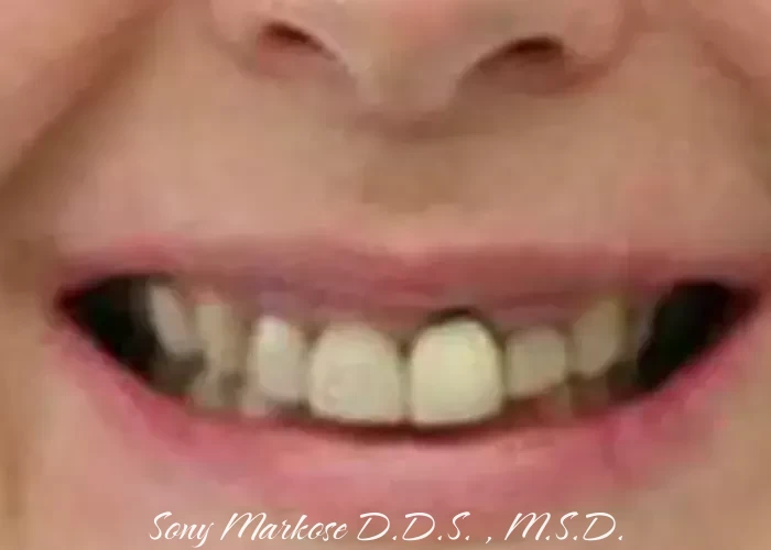 Immediate Dentures in Carrollton