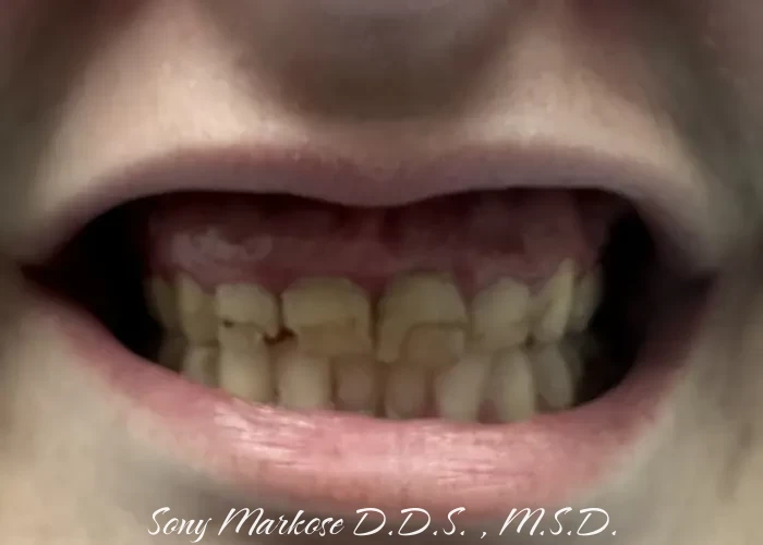 Immediate Dentures fixing in Carrollton