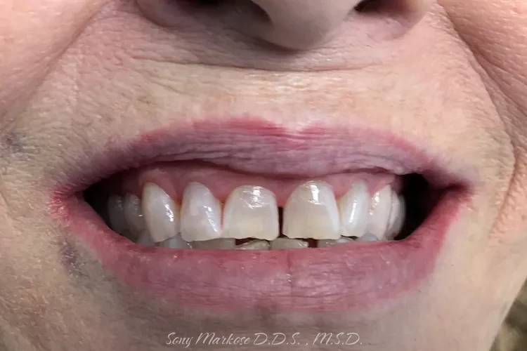 Dental Veneers fixing in Carrollton
