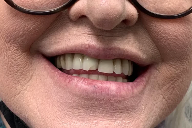 Dentures in Carrollton