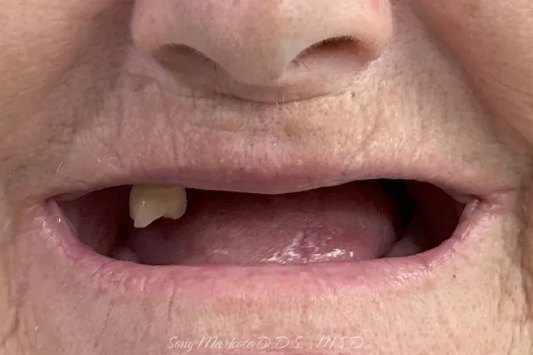 Denture fixing in Carrollton