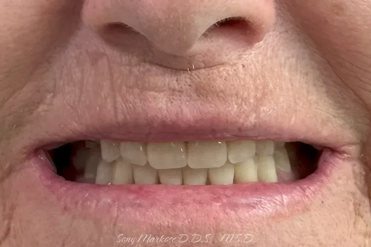 Denture fixing in Carrollton