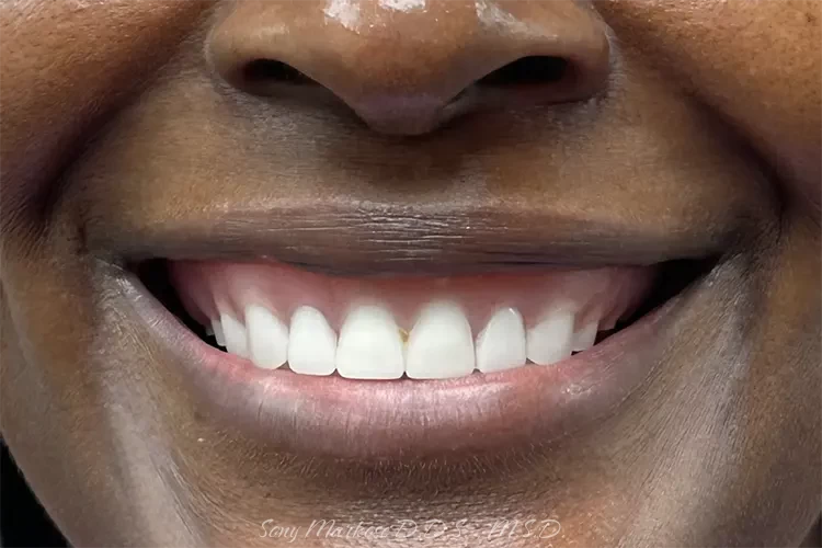 Denture in Carrollton