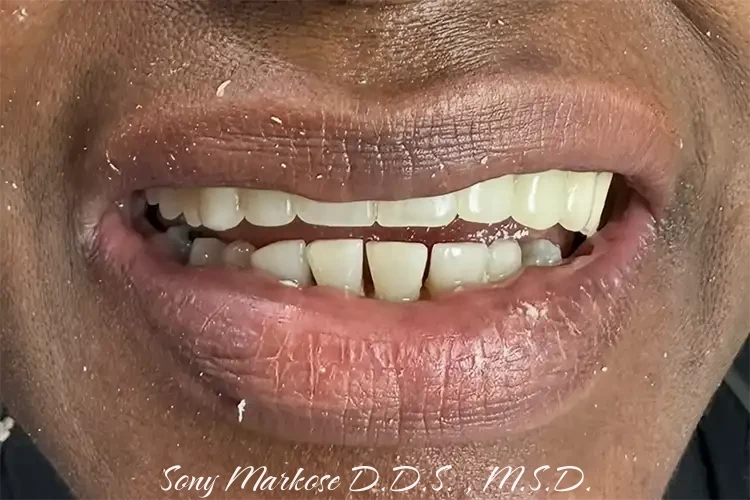 Denture in Carrollton