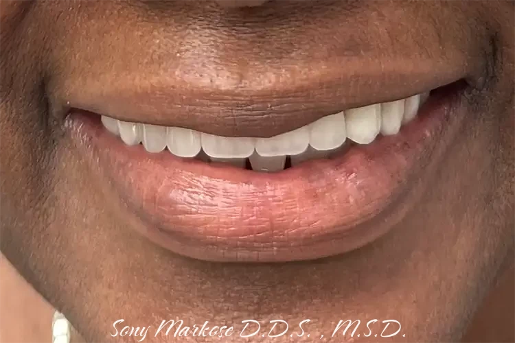 Denture in Carrollton