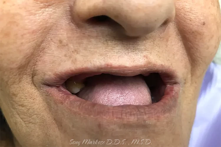 Full Dentures in Carrollton Texas