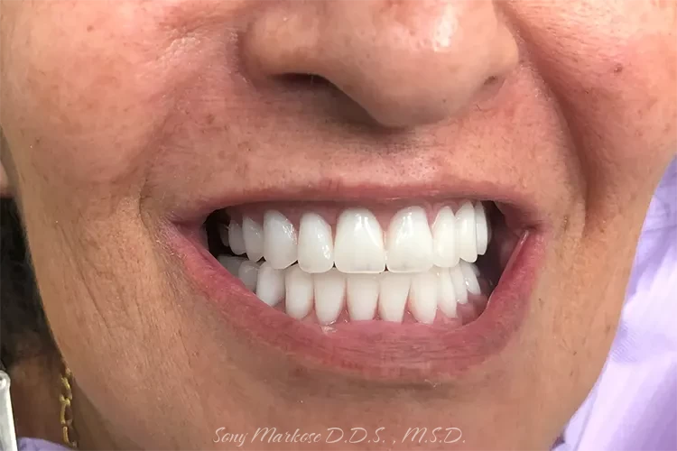 Full Dentures in Carrollton Texas