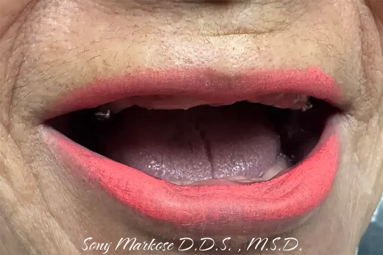 Denture near Carrollton