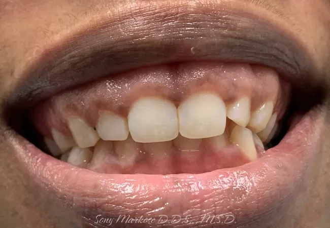 E-Max Veneers in Carrollton