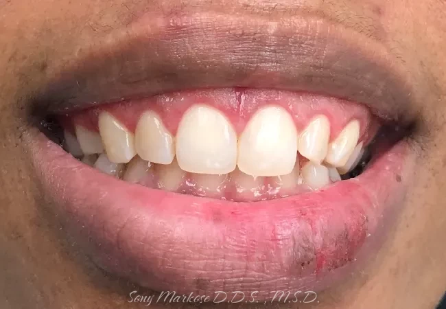 E-Max Veneers in Carrollton