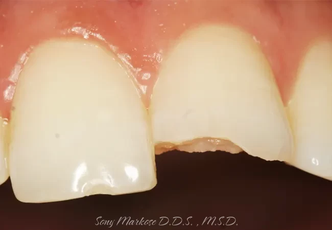 Dental Composite Bonding in Carrollton