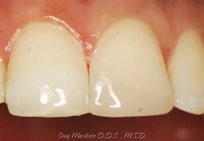 Dental Composite Bonding in Carrollton