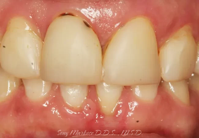 E-Max Veneers in Carrollton