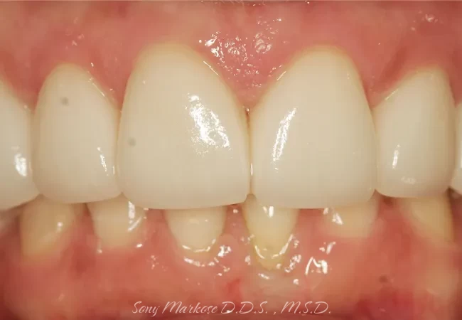 E-Max Veneers in Carrollton