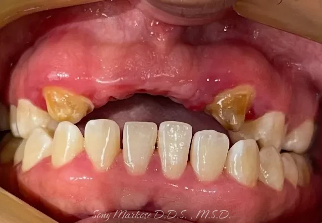 Mini Implant Hybrid in Carrollton
