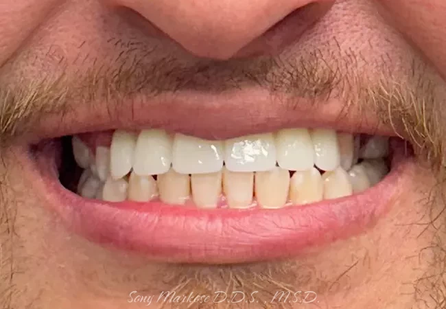 Mini Implant Hybrid in Carrollton
