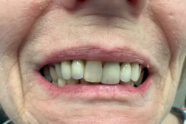 Denture fixing in Carrollton