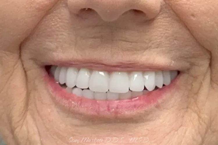 Denture fixing in Carrollton