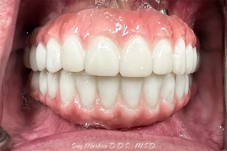 Hybrid denture in Carrollton upper and lower before and after