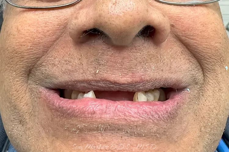 Hybrid Denture fixing Clinic in Carrollton