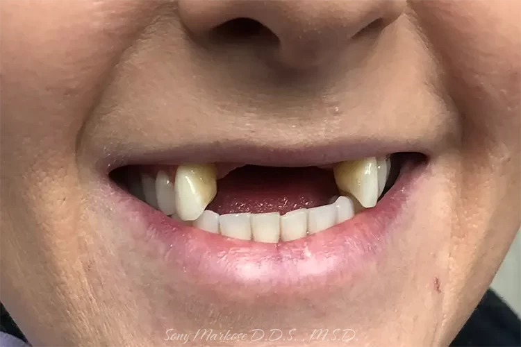 Multiple Teeth Replacements in Carrollton