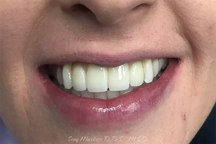Multiple Teeth Replacements in Carrollton