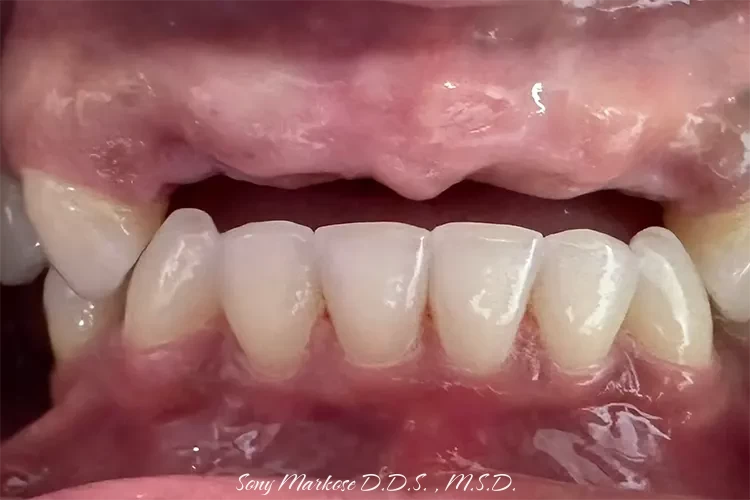 Partial denture before and after in Carrollton