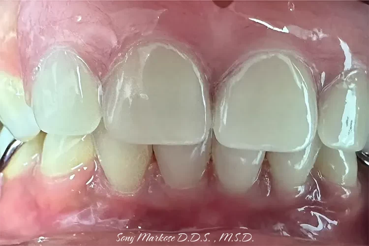 Partial denture before and after in Carrollton