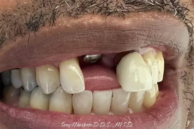 Single implants in Carrollton