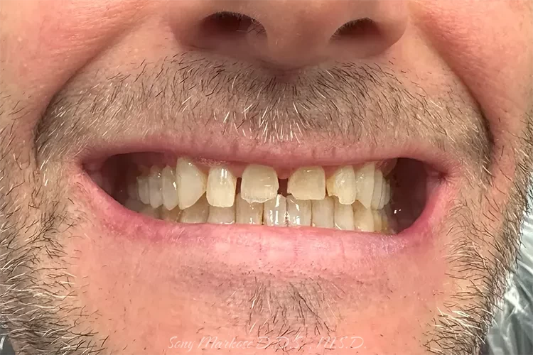 Zirconia Reconstruction in Carrollton