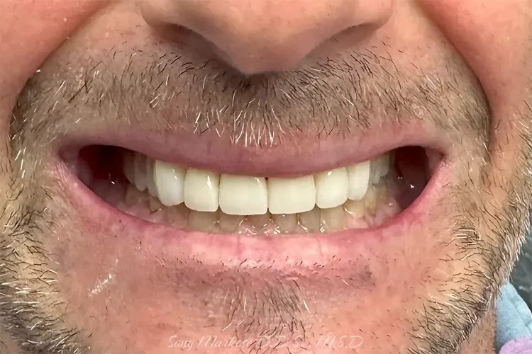 Zirconia Reconstruction in Carrollton