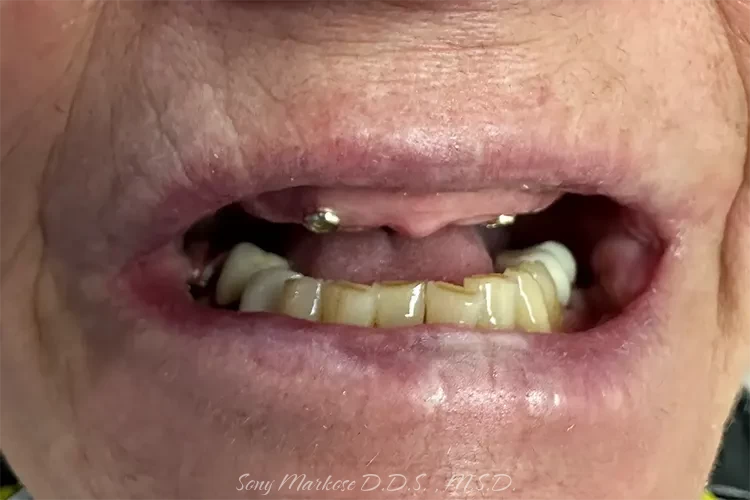 Snap on denture before and after Carrollton