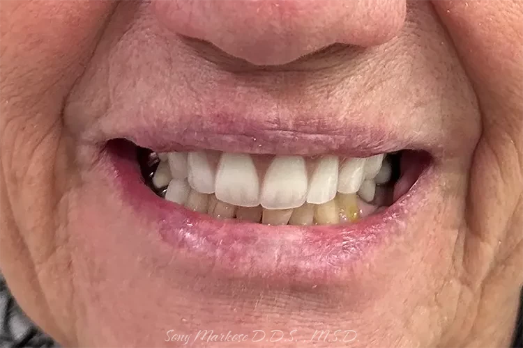 Snap on denture before and after Carrollton