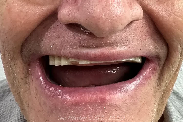 Snap on denture before and after Carrollton